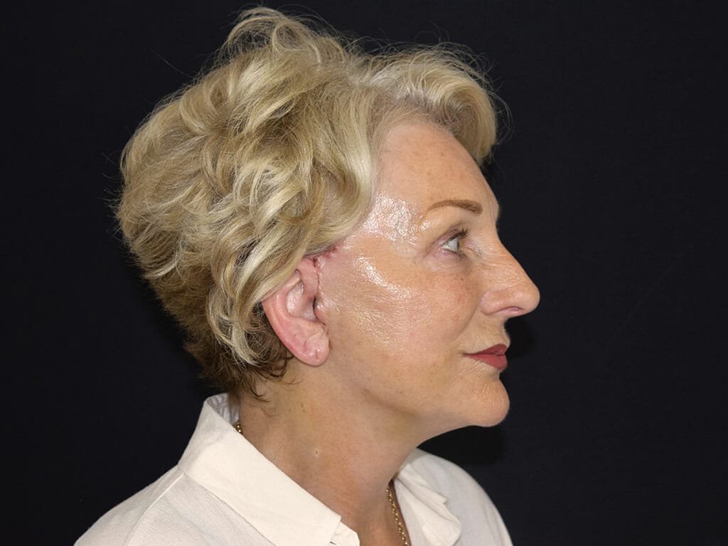 Maureen one week after her Concept Facelift