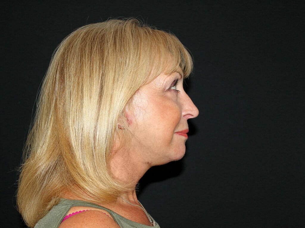 Nita one week after her Concept Facelift