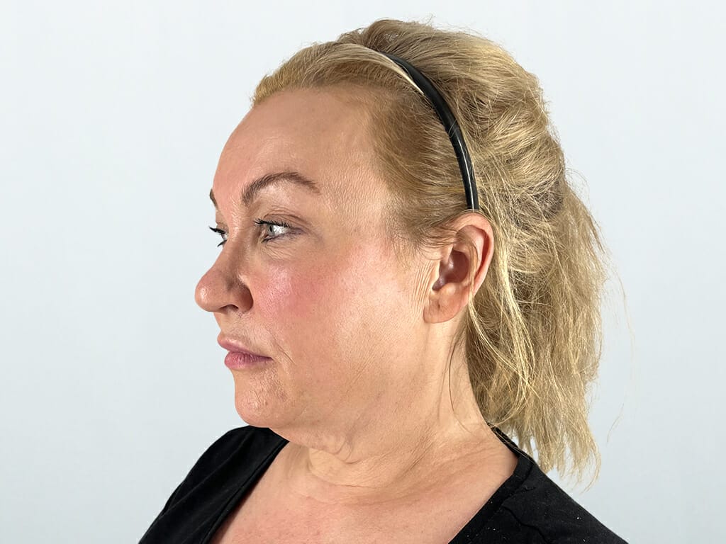 Woman before Concept™ Face and Neck Lift surgery at Bella Vou