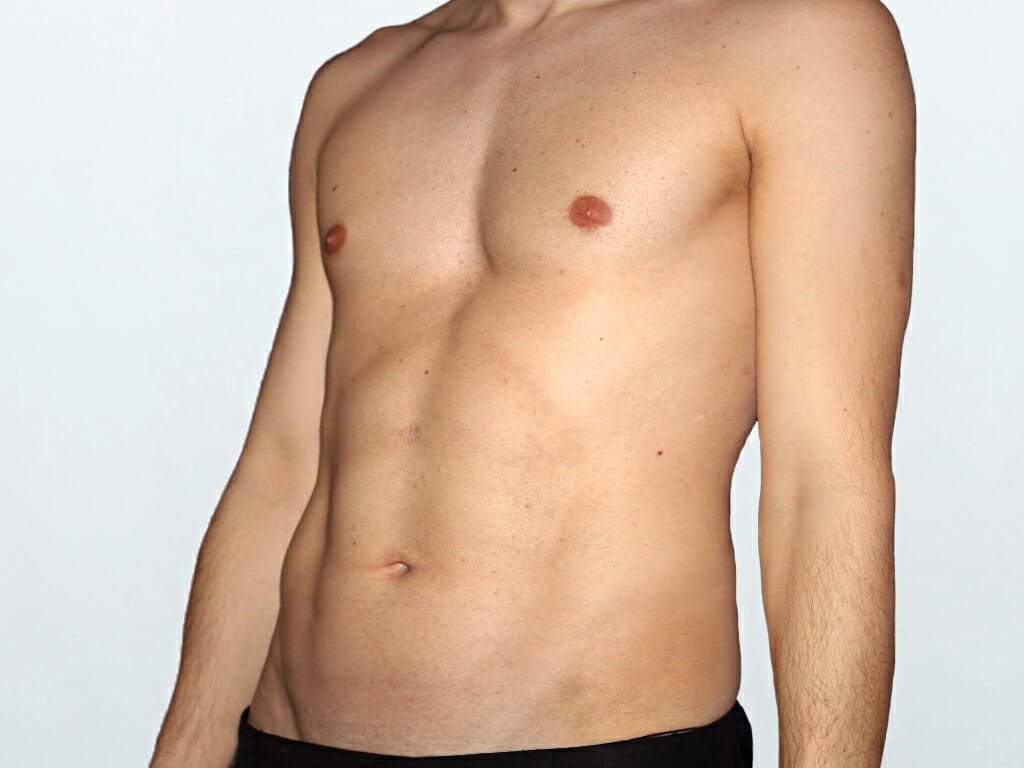 Man 1 year after Vaser Liposuction to the Abdomen at Bella Vou