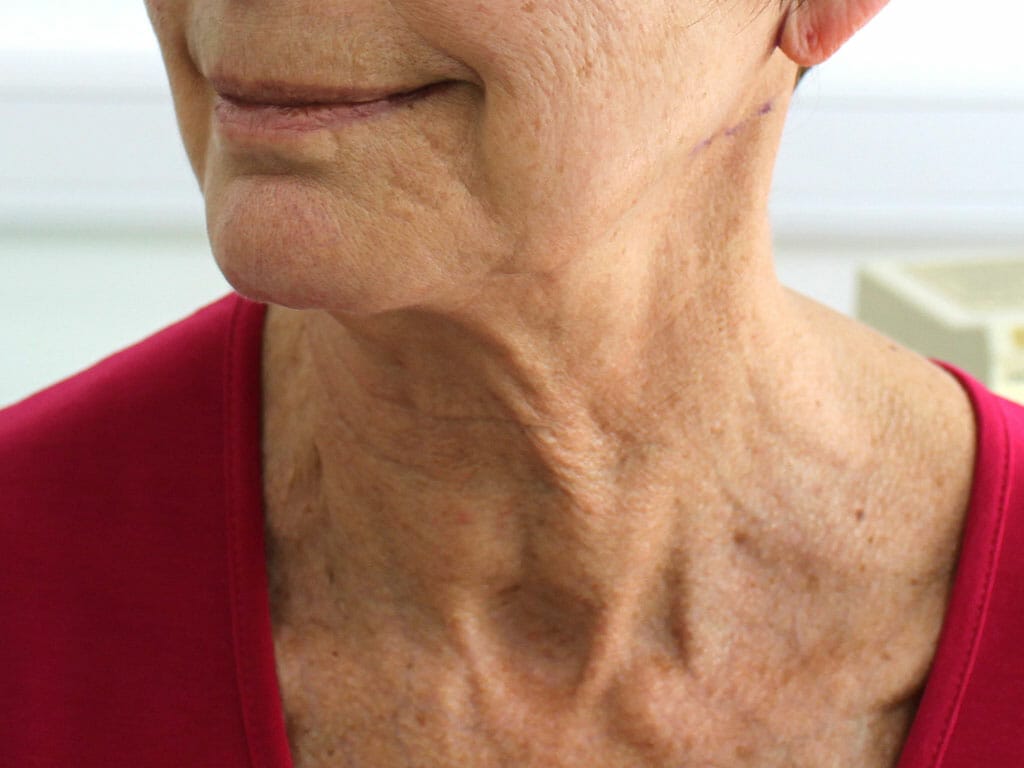 Sally before her Neck Lift