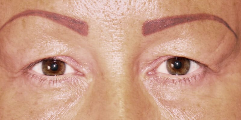 Woman before her Upper Eyelid surgery