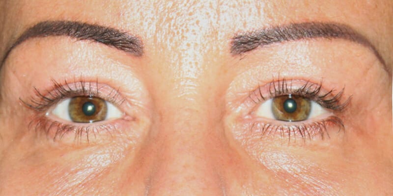 Woman 1 year after her upper eyelid surgery