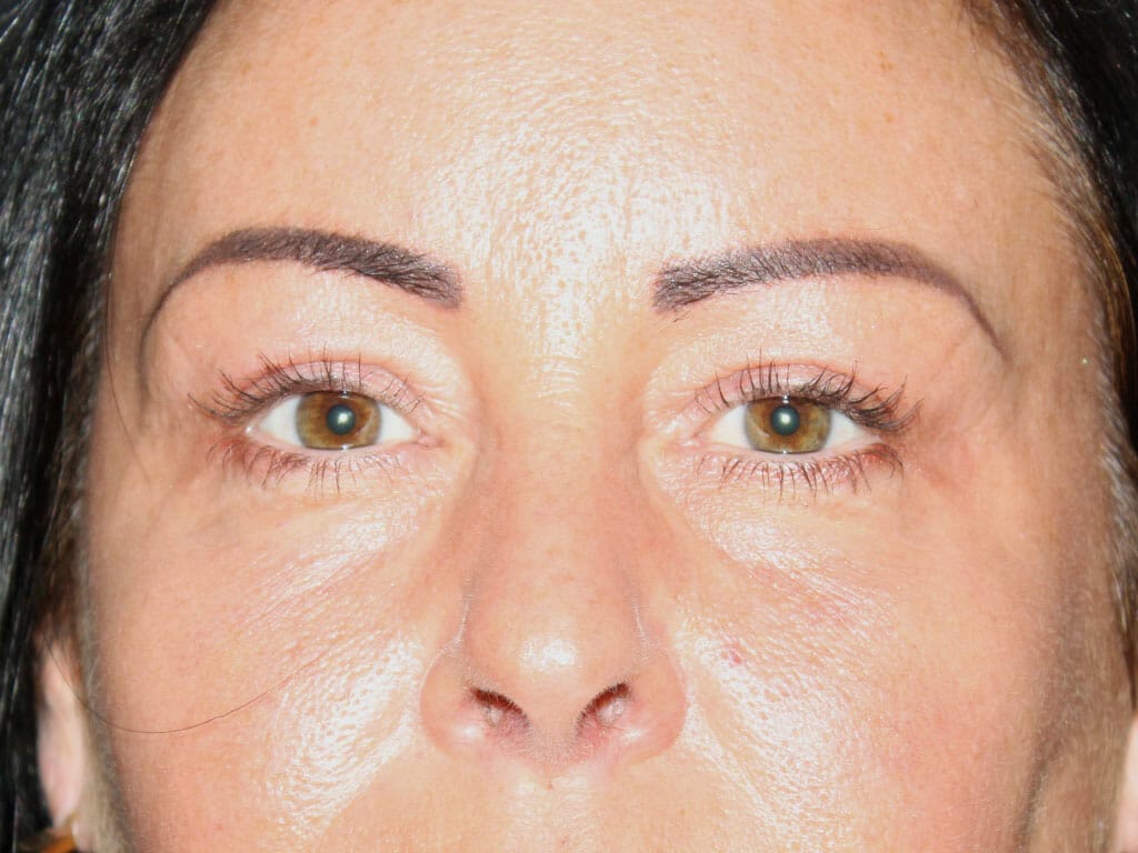 Tina one year after her Eyelid Surgery