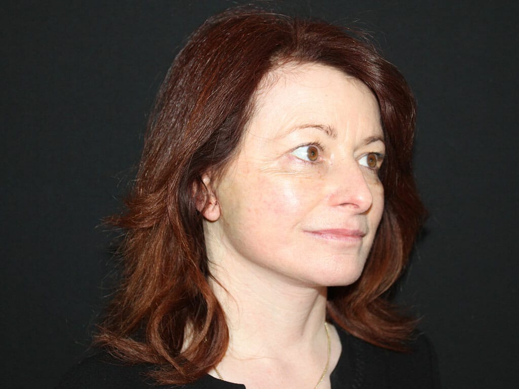 Wendy one day after her Concept Facelift