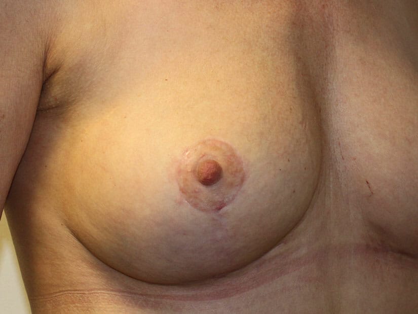 Anon after Areola Reduction surgery at Bella Vou