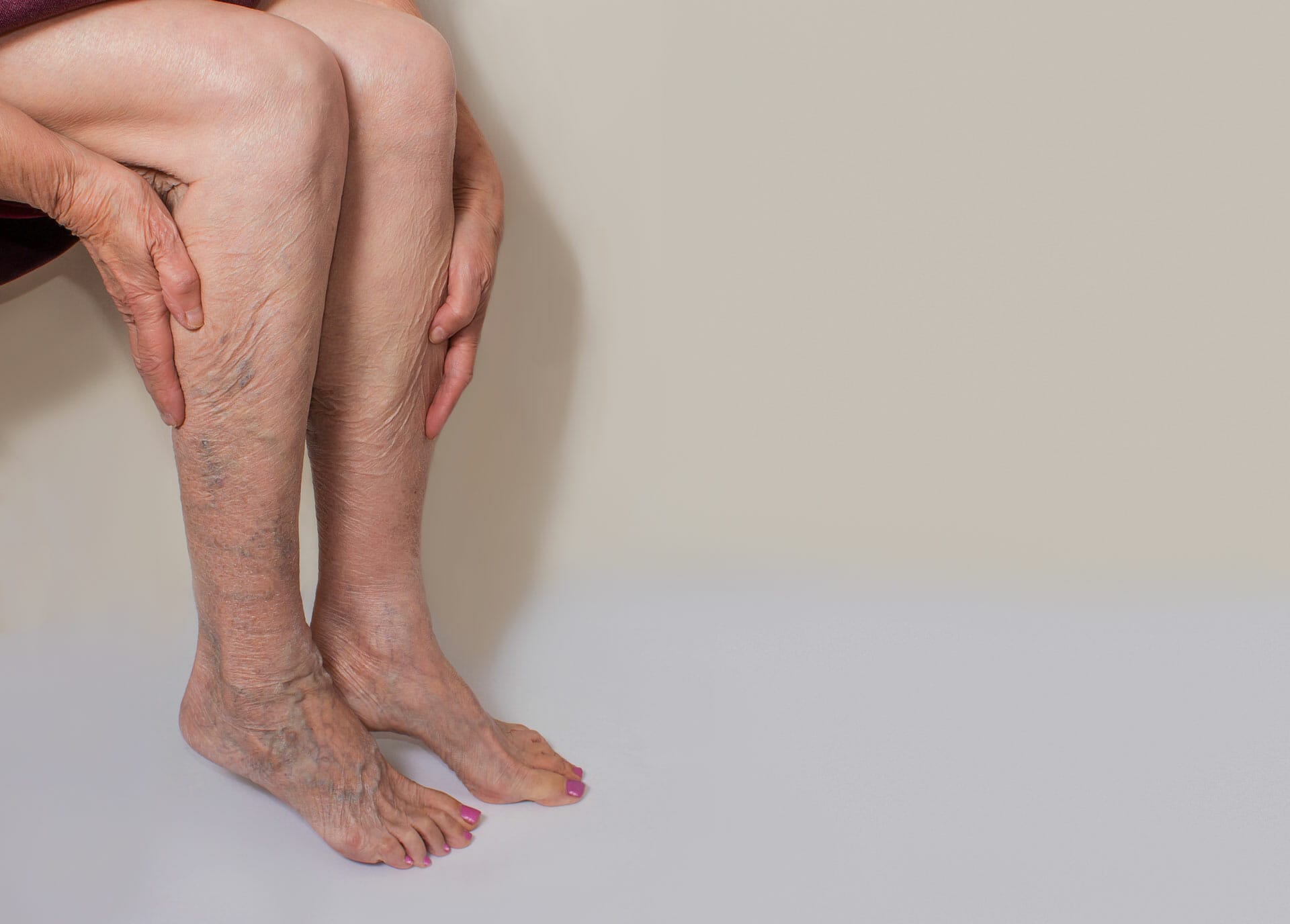 varicose-veins-on-a-female-legs Varicose veins on a female legs