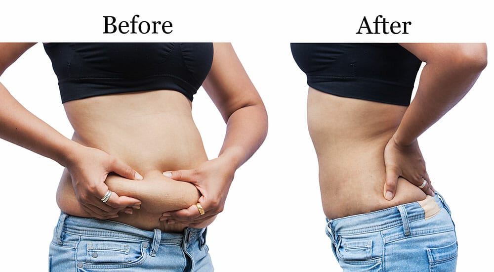 Before & After comparison of Tummy Tuck and Weight Loss surgery at Bella Vou